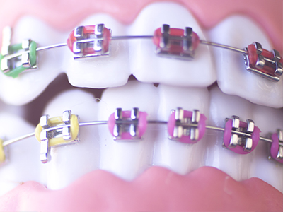 Braces with colorful bands and metal brackets.